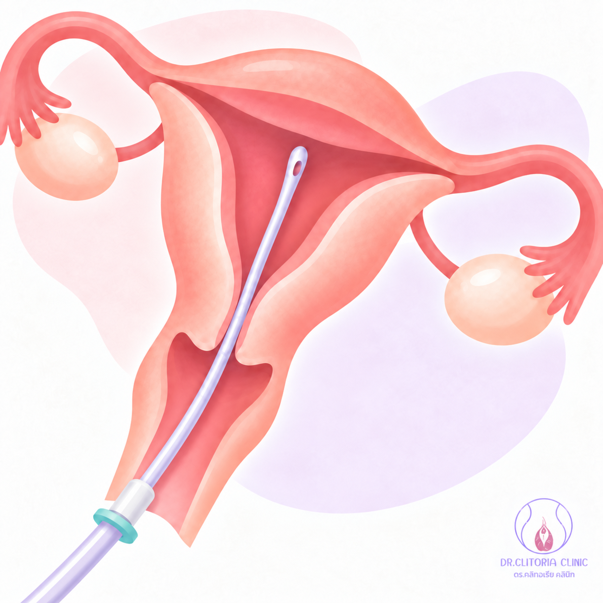 ตรวจชิ้นเนื้อ ตรวจชิ้นเนื้อโพรงมดลูก ตัดชิ้นเนื้อ endometrial sampling biopsy ตรวจชิ้นเนื้อ ตรวจชิ้นเนื้อโพรงมดลูก ตัดชิ้นเนื้อ endometrial sampling biopsy