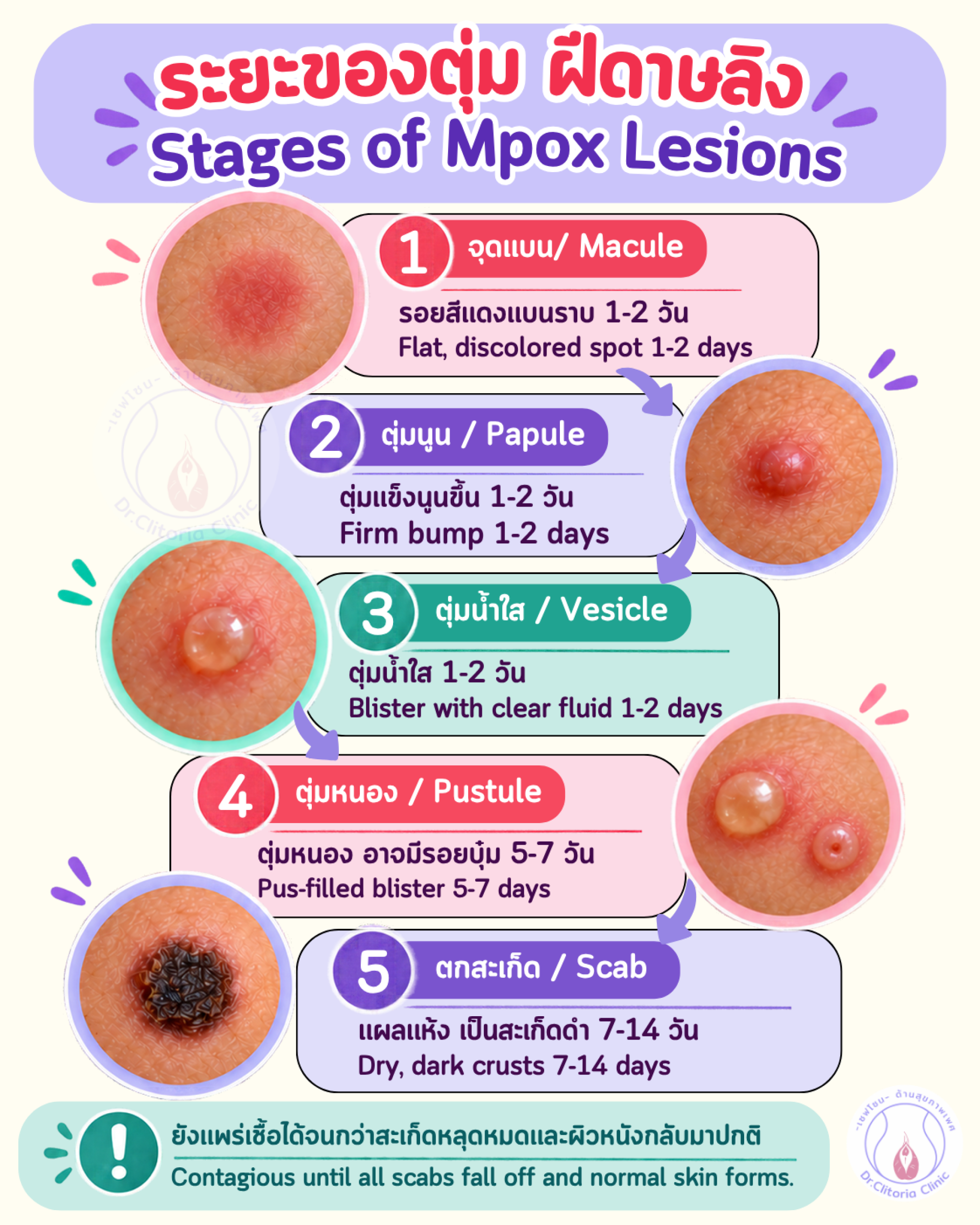 ฝีดาษลิง ตุ่ม, ฝีดาษลิง ระยะของตุ่ม, mpox, mpox scab stages, mpox bump ฝีดาษลิง ตุ่ม, ฝีดาษลิง ระยะของตุ่ม, mpox, mpox scab stages, mpox bump
