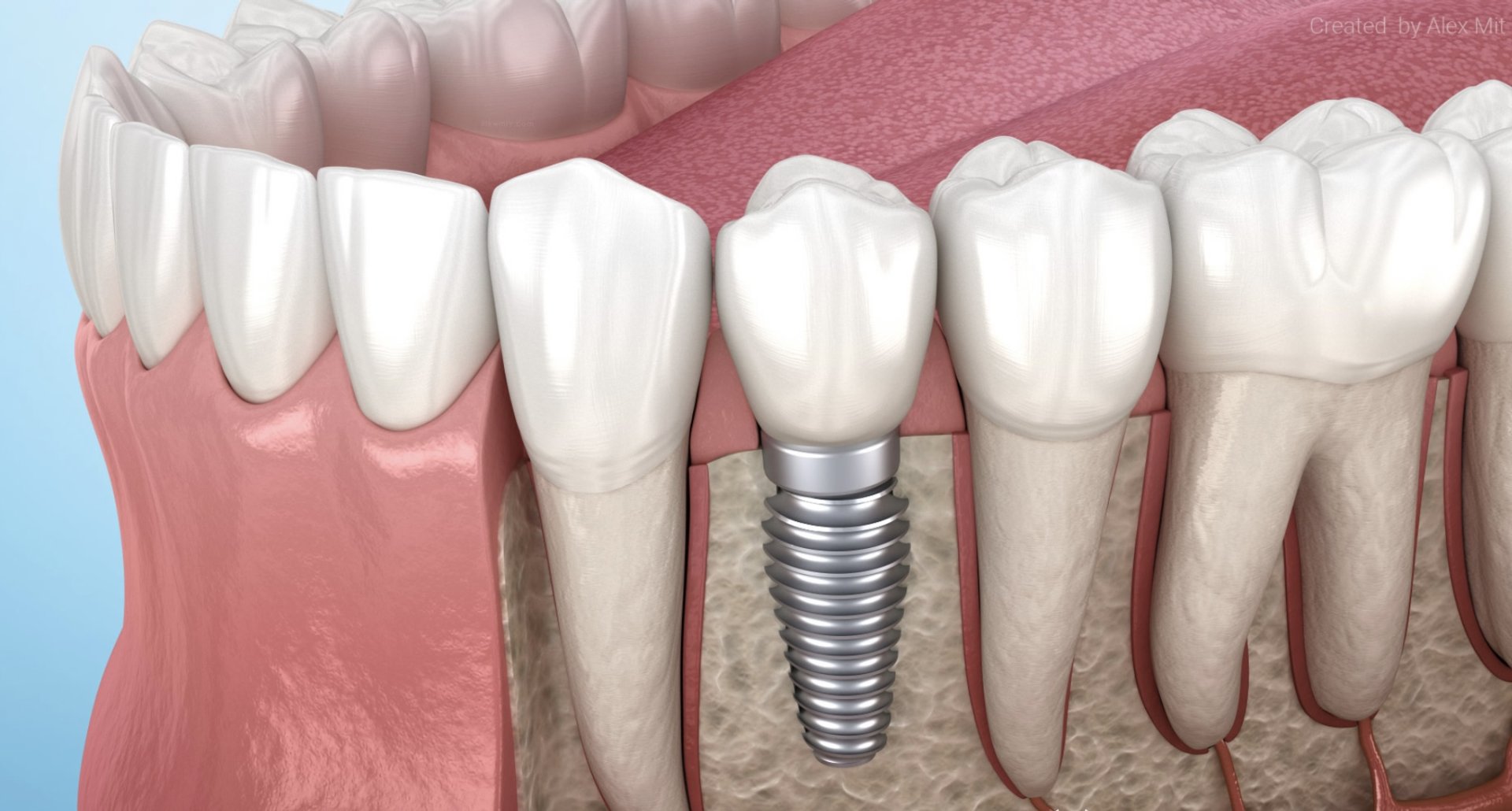 implant รากเทียม ทำรากเทียม รากเทียมนครพนม implant รากเทียม ทำรากเทียม รากเทียมนครพนม