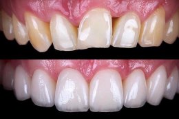 Dental Veneer