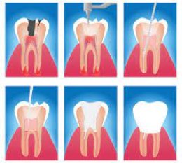 Endodontic Dentistry