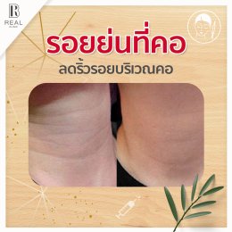 จุดฉีดฟิลเลอร์ที่คุณไม่อาจ ไม่เคยรู้มาก่อน