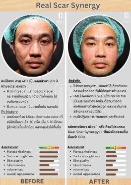 ฟื้นฟูหลุมสิว หลุมสิว หลุมสิวเกาหลี รักษาหลุมสิว ผ่าตัดหลุมสิว  ศัลยกรรมหลุมสิว เย็บหลุมสิว รักษาหลุมสิวเกาหลี เติมเต็มหลุมสิว ฉีดหลุมสิว รีวิวหลุมสิว รีวิวรักษาหลุมสิว dr ramita ฟิลเลอร์หลุมสิว Realclinic subcision ผ่า ตัดพังผืด ตัดผังผืด ผ่าตัดหลุมสิวเก