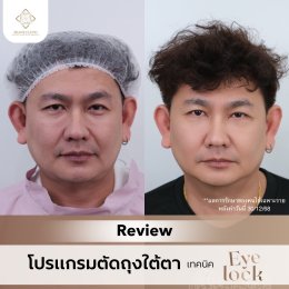 ถุงใต้ตาบวมใหญ่ แก้ด้วยฟิลเลอร์แล้วเป็นก้อน? ทำไมวัย 50+ ถึงควรเลือก ตัดถุงใต้ตาเทคนิค Eyelock แทน