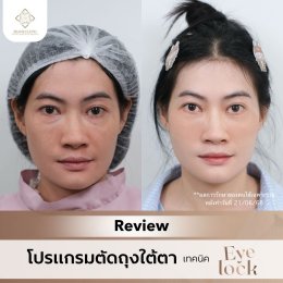 ถุงใต้ตาบวมใหญ่ แก้ด้วยฟิลเลอร์แล้วเป็นก้อน? ทำไมวัย 50+ ถึงควรเลือก ตัดถุงใต้ตาเทคนิค Eyelock แทน