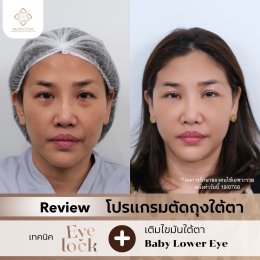 ถุงใต้ตาบวมใหญ่ แก้ด้วยฟิลเลอร์แล้วเป็นก้อน? ทำไมวัย 50+ ถึงควรเลือก ตัดถุงใต้ตาเทคนิค Eyelock แทน