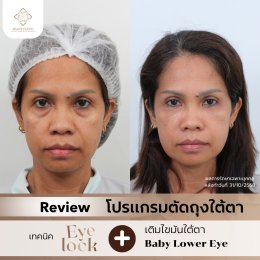 ร่องใต้ตาลึกจากกระดูกยุบตัว... ทำไมแค่ "ตัดถุงใต้ตา" อย่างเดียวถึงไม่พอสำหรับวัย 50+?