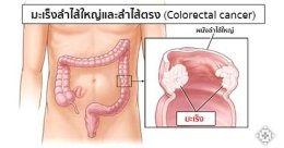  5 สัญญาณต่อไปนี้ เสี่ยงเป็นมะเร็งลำไส้ เช็คด่วนเลยคะ  ถ้าหากมี 5 อาการนี้เสี่ยงเป็นมะเร็งลำไส้!