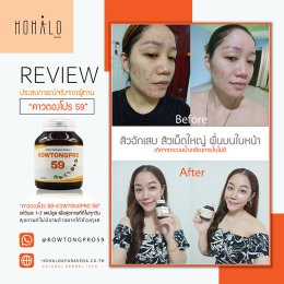 ปัญหาผิวสะเก็ดเงินรุมเร้า เราจะทำยังไงดี มีวิธีแก้ยังไงได้บ้าง?