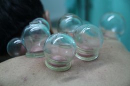 การครอบแก้ว ครอบกระปุก (Cupping Therapy)