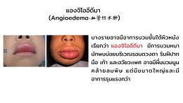 การรักษาลมพิษโดยศาสตร์แพทย์แผนจีน Urticaria