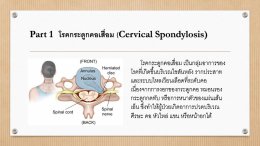 โรคกระดูกคอเสื่อม Cervical Spondylosis  