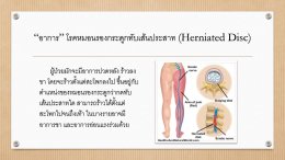 โรคหมอนรองกระดูกทับเส้นประสาท Herniated Disc