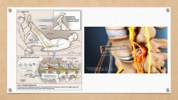 โรคหมอนรองกระดูกทับเส้นประสาท Herniated Disc
