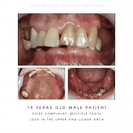 BFC Full Mouth Implant Rehabilitation With Full Digital Workflow