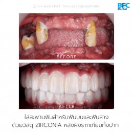 Full Mouth Implants With Full Digital Workflow in 7 Days