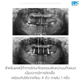 BFC เคสฝังรากเทียมทั้งปากสำหรับขากรรไกรบน (ฟันบน) ด้วยระบบ Digital พร้อมมีฟันภายใน 7 วัน 