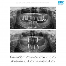 Full Mouth Implant Rehabilitation With Full Digital Workflow in 7 Days Case by Dr.Manapat Thaveeprungsiporn