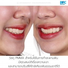 BFC เคสฝังรากเทียมทั้งปากสำหรับขากรรไกรบน (ฟันบน) ด้วยระบบ Digital พร้อมมีฟันภายใน 7 วัน 