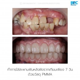 Full Mouth Implant Rehabilitation With Full Digital Workflow in 7 Days Case by Dr.Manapat Thaveeprungsiporn