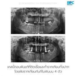 Full Mouth Implant Rehabilitation (for Upper Arch) With Full Digital Workflow in 7 Days 