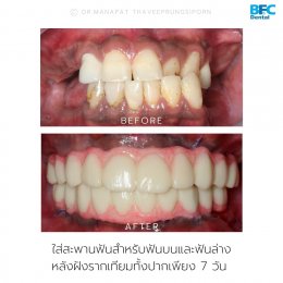 Smile Transformation in 7 Days 