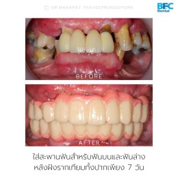 S - Arch Concept Case (Short Arch Occlusion with Immediate Loading Protocols) 4 Upper Implants and 4 Lower Implants