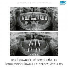 S - Arch Concept Case (Short Arch Occlusion with Immediate Loading Protocols) 4 Upper Implants and 4 Lower Implants