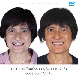 Full Mouth Implants With Full Digital Workflow in 7 Days Case by Dr.Manapat Thaveeprungsiporn