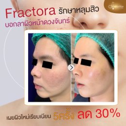 Fractora หลุมสิว