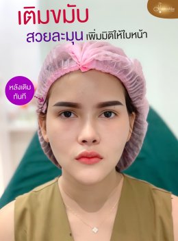 Filler ขมับ