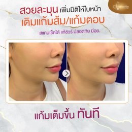 Filler แก้มส้ม แก้มตอบ
