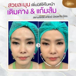 Filler แก้มส้ม แก้มตอบ
