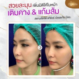 Filler แก้มส้ม แก้มตอบ