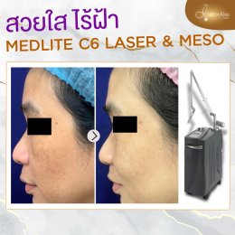 Medlite ฝ้า กระ รอยดำ