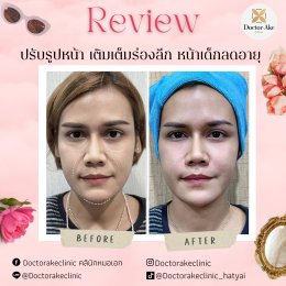 Filler ปรับรูปหน้า
