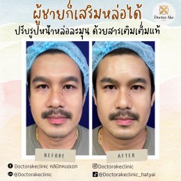Filler ปรับรูปหน้า