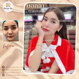 Filler ปรับรูปหน้า