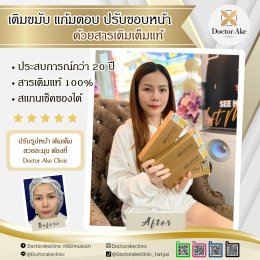 Filler ปรับรูปหน้า