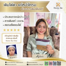 Filler ปรับรูปหน้า