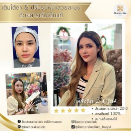 Filler ปรับรูปหน้า