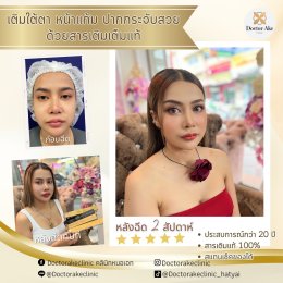 Filler ปรับรูปหน้า
