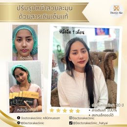 Filler ปรับรูปหน้า