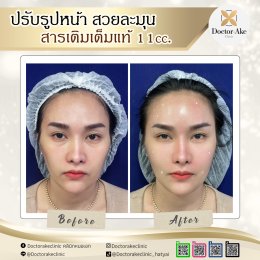 Filler ปรับรูปหน้า