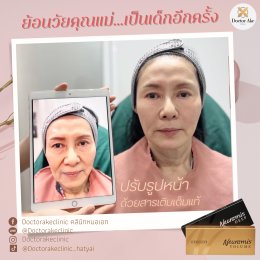 Filler ปรับรูปหน้า