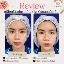 Filler คาง
