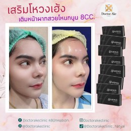 Filler หน้าผาก