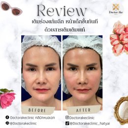 Filler ร่องแก้ม Nasolabial Folds