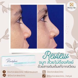 Filler จมูก