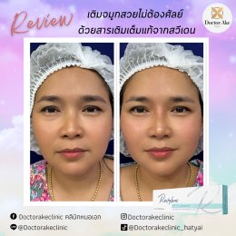 Filler จมูก